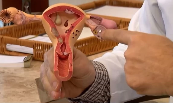 Aberta chamada pública para pesquisas sobre endometriose