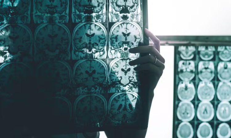 Estudo identifica células imunes que podem proteger o cérebro contra o avanço do Alzheimer